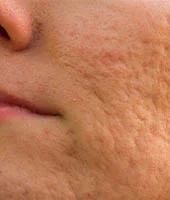 Acne scars