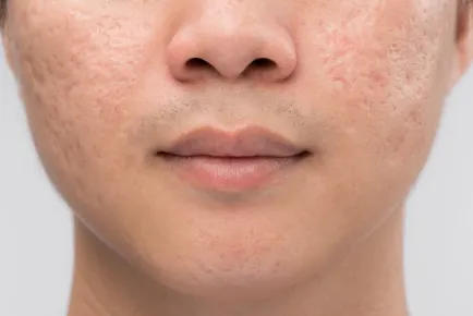 Acne Scars