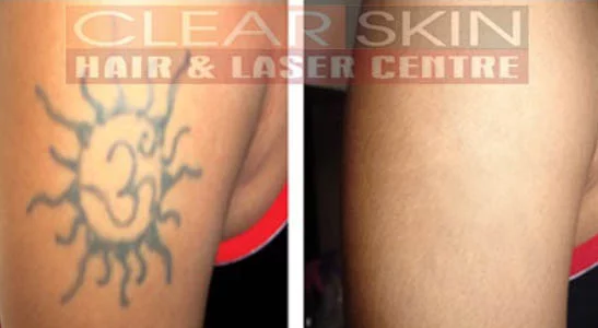 Clear Skin Hair and Laser Centre