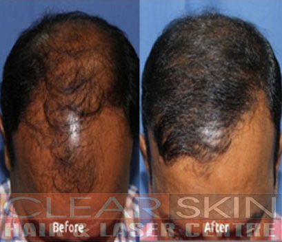 Advance Hair Treatment
