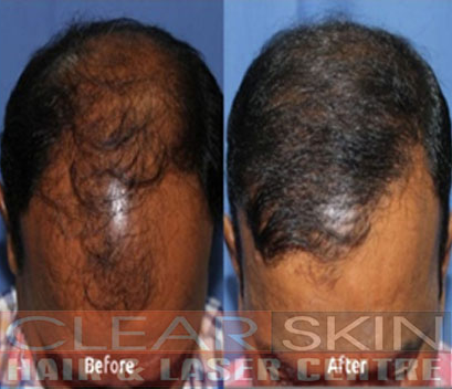 Hair Transplantation