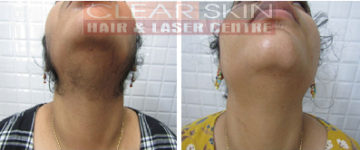 Laser Hair Removal