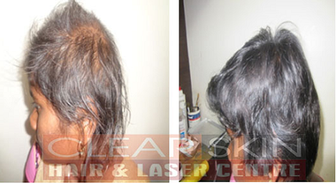 Advance Hair Treatment in Kurnool