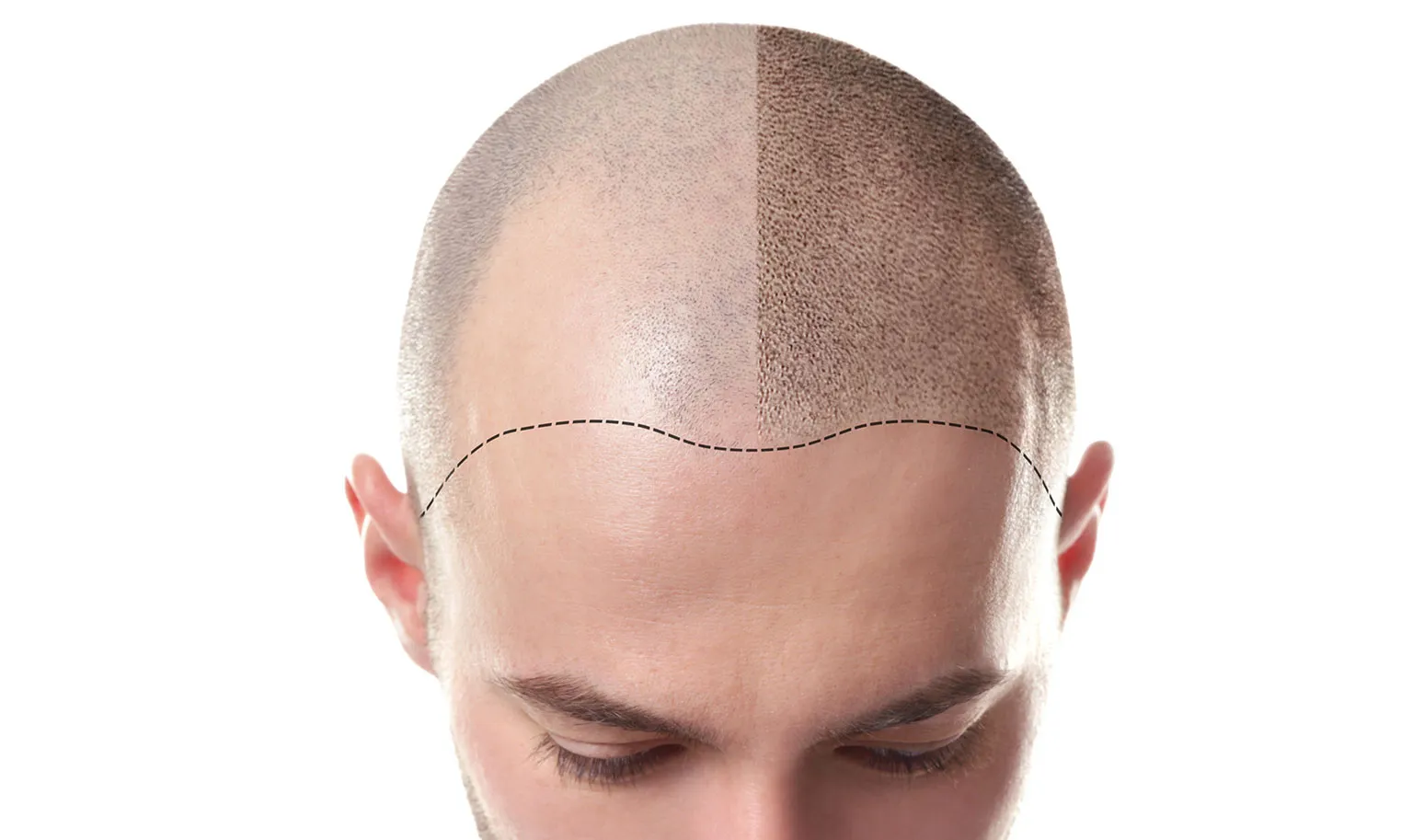 SCALP MICRO PIGMENTATION