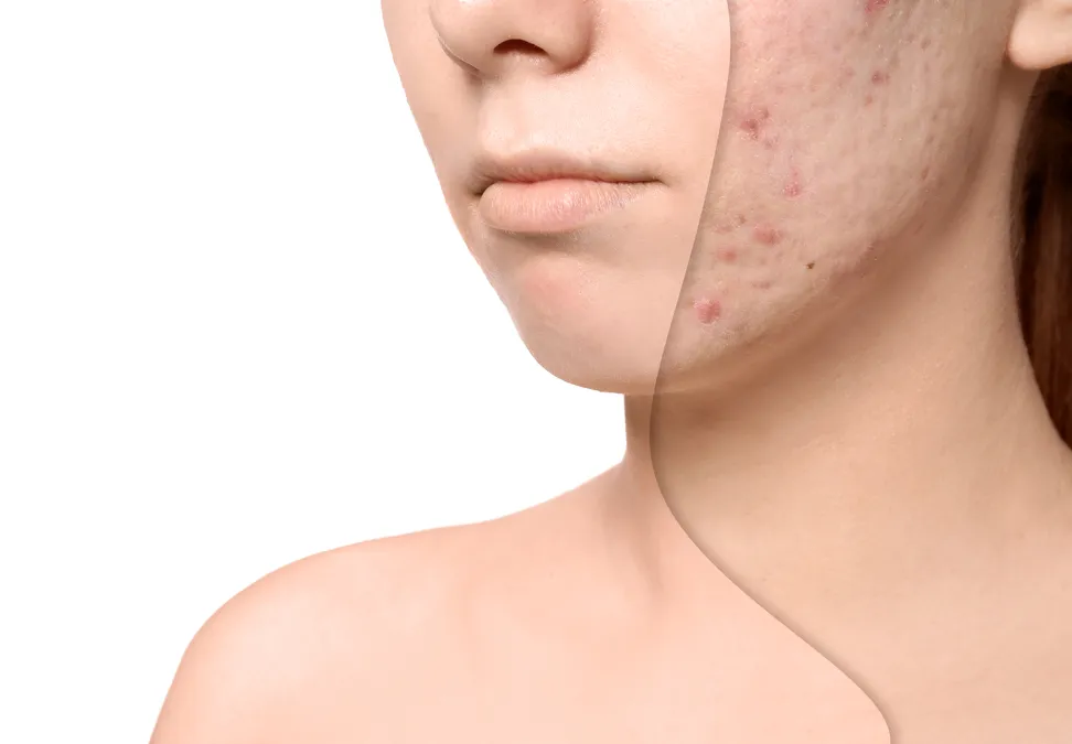 Acne Scars