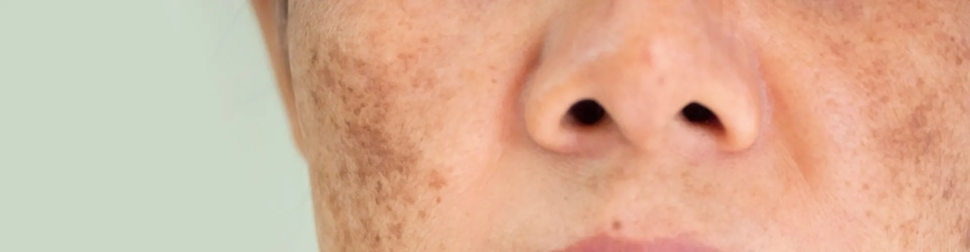 Melasma