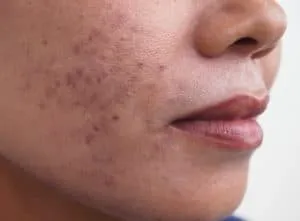 Melasma