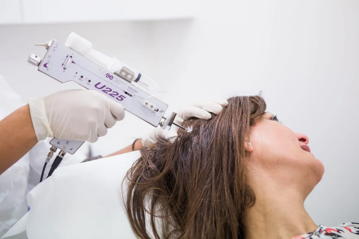 MESOTHERAPY HAIR LOSS