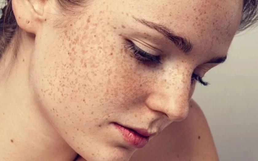 Skin Pigmentations Disorders