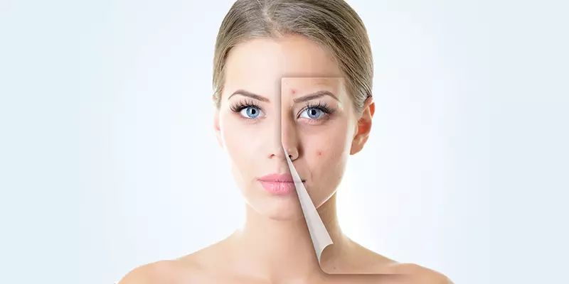 Preventive Tips For Pimple Free Skin
