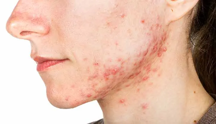 SEVERE ACNE