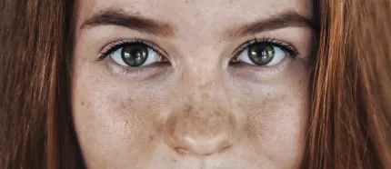 Skin pigmentation or Skin Hyperpigmentation