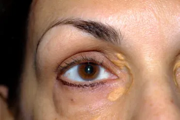 Xanthelasma