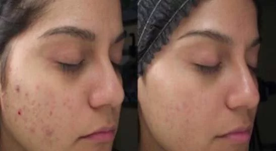 Facial/Skin Rejuvenation