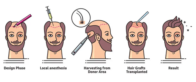 Advantage for Hair transplants