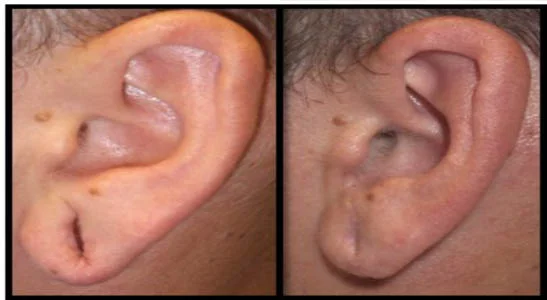 Ear Hole Repair