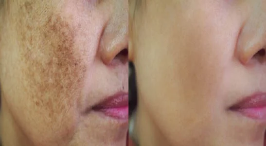 Melasma