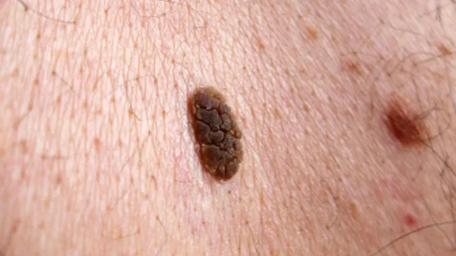 Seb Karatosis