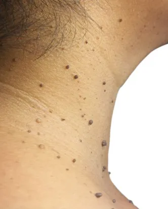 Skin Tags