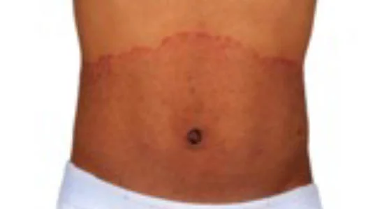 Tinea