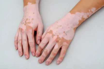 Vitiligo