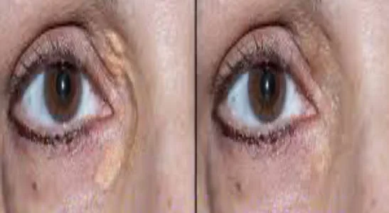 Xanthelasma Treatment